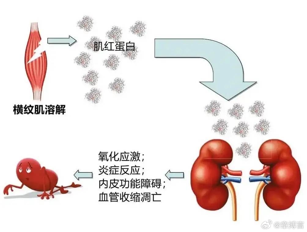 深蹲惩罚引发横纹肌溶解事件，教育方式与健康边界的反思