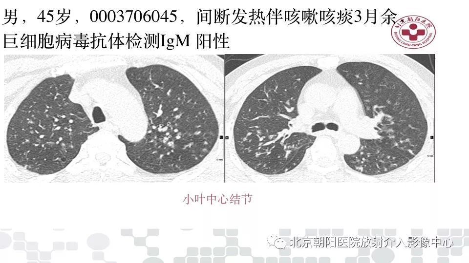 甲流后发烧引发病毒性肺炎，经历及警示