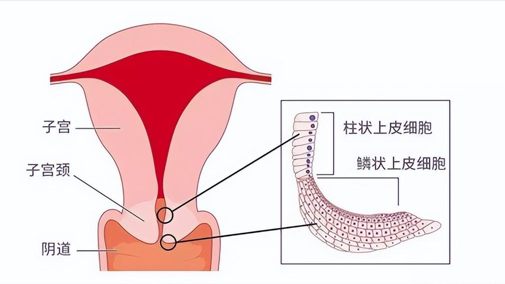 多数人感染HPV后两年内可自愈，了解、预防与应对