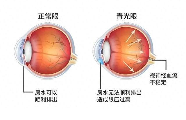 眼睛出现三种情况需警惕青光眼